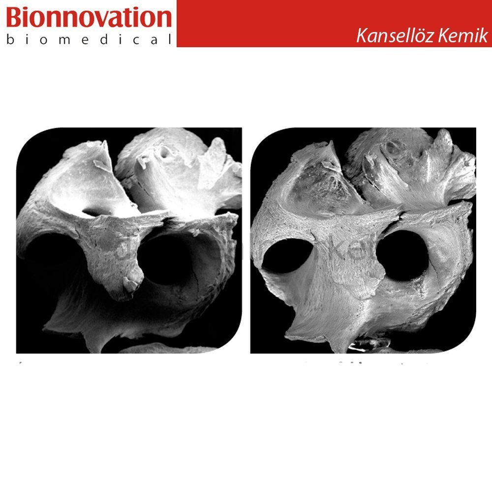 Bionnovation - Bonefill Prous (Cancellous) Bovine Graft - Xenograft - 5 gr (15cc)