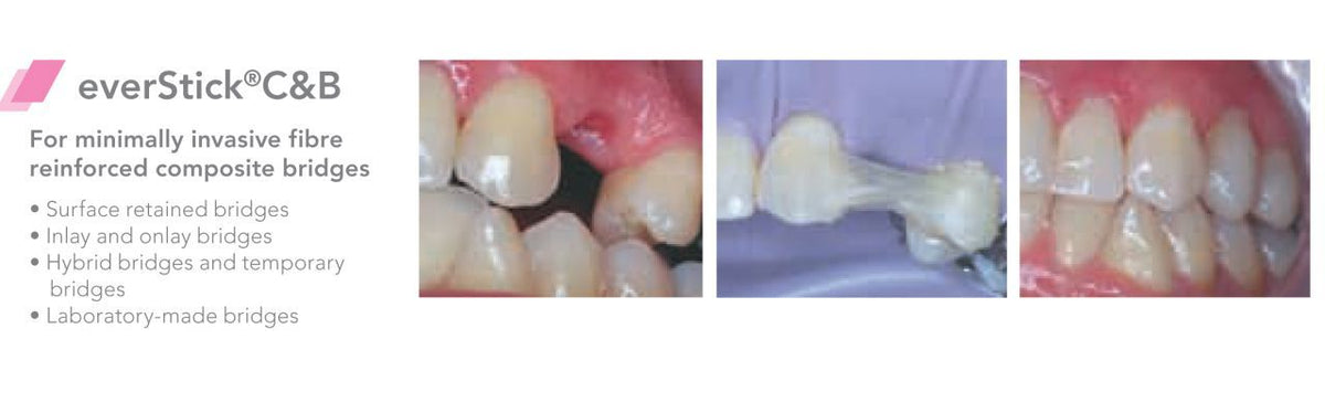 Gc Dental - EverStick C&B - Fibre Reinforcement for Composite Bridges