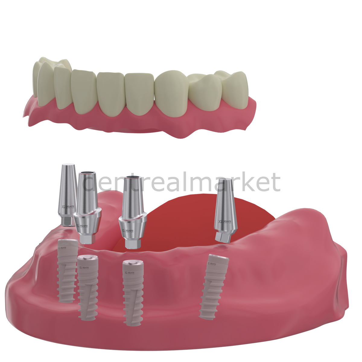 DentrealStore - X-Gate Dental X3 Internal Hex Implant Body - Diameter 3.3 mm - Single Platform Implant