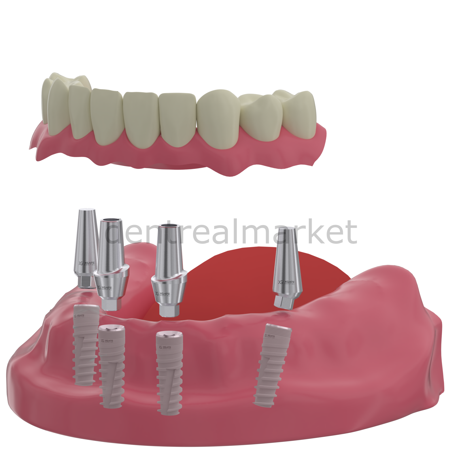 DentrealStore - X-Gate Dental X3 Internal Hex Implant Body - Diameter 4.2 mm - Single Platform Implant