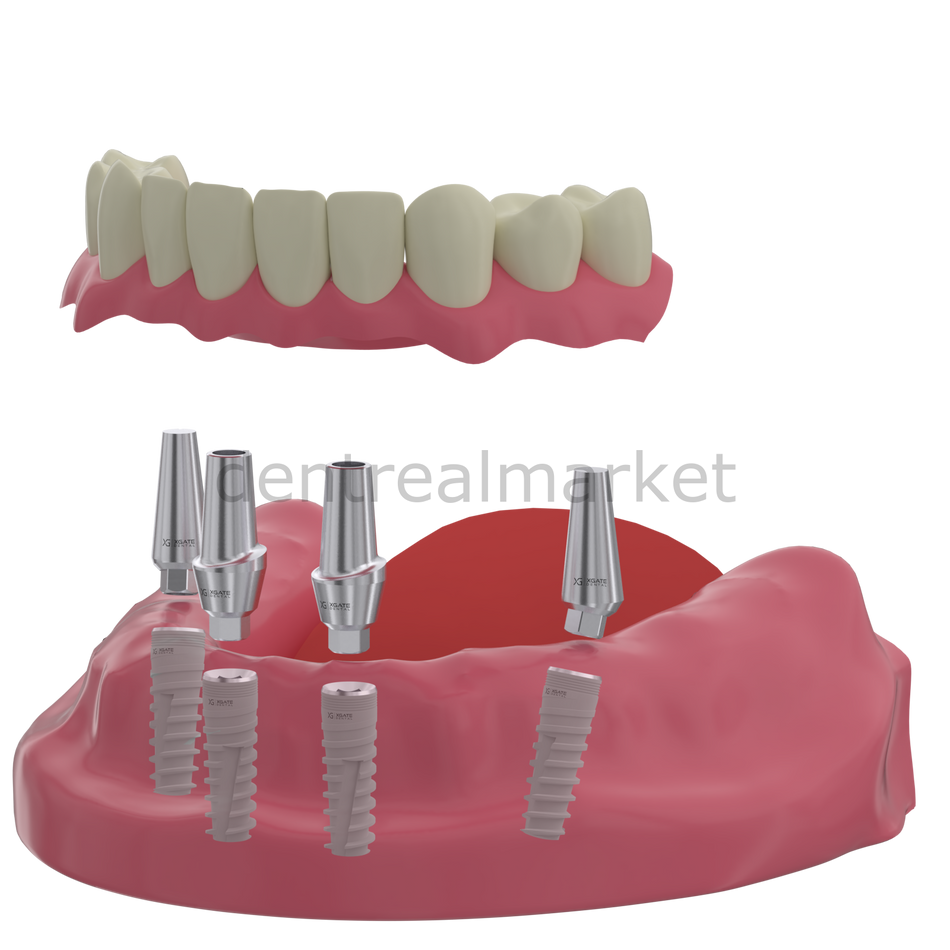 DentrealStore - X-Gate Dental X3 Internal Hex Implant Body - Diameter 4.2 mm - Single Platform Implant