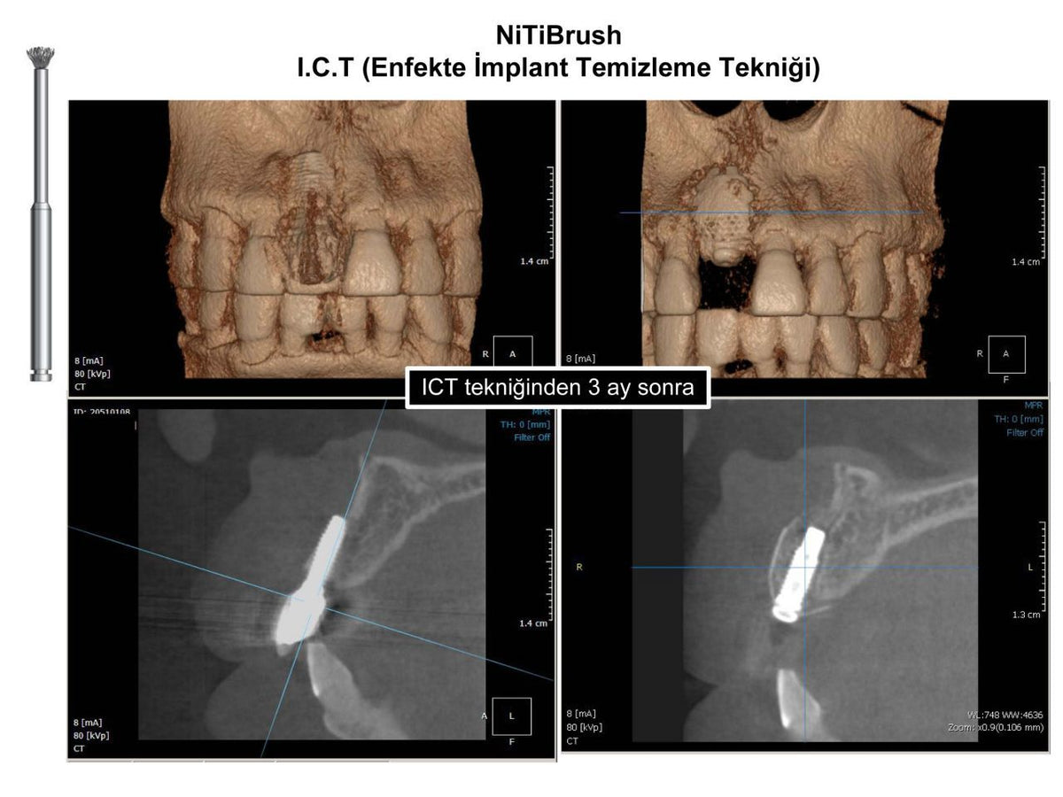 Dentkonsept - Nitibrush Peri - Implantitis Bur Nano