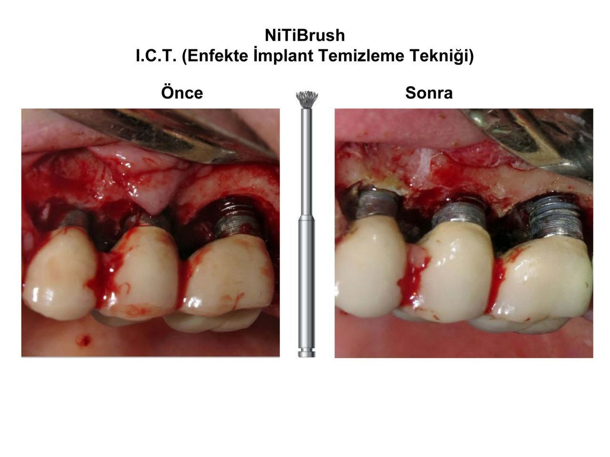 Dentkonsept - Nitibrush Peri - Implantitis Bur Refill Pocket