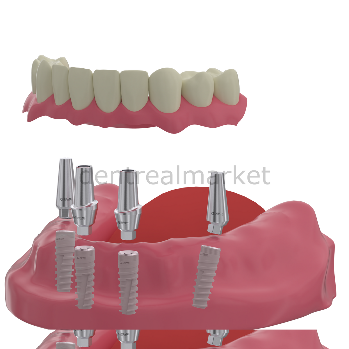 X - Gate Dental - X3 Internal Hex Implant Body - Diameter 4.2 mm - Single Platform Implant